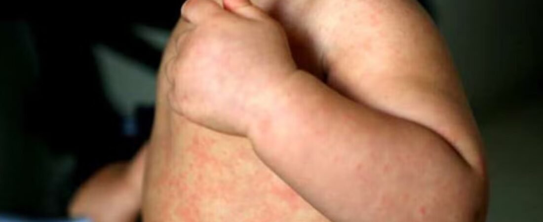 México rebasa los 10 mil casos de sarampión